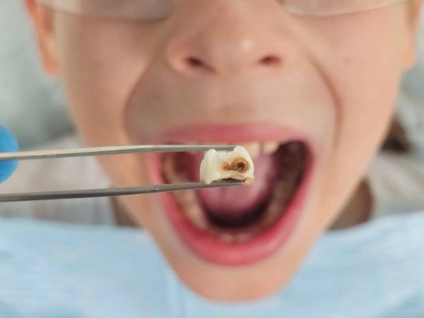 Best Emergency Treatment for Dental Infections or Abscesses in Quitman, TX
